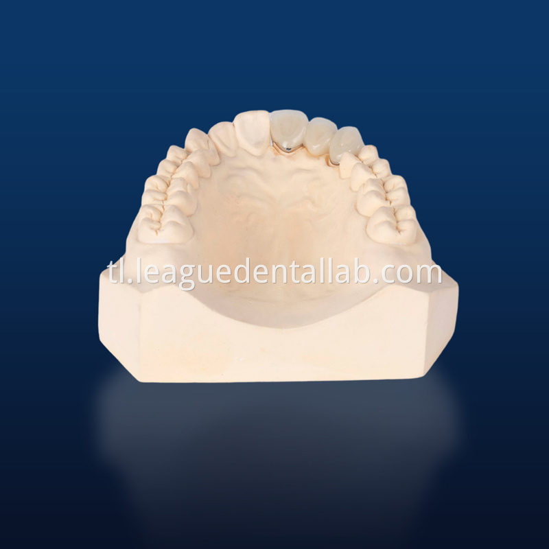 PFM,Metal crown,Fixed metal crown